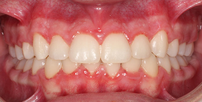 Teeth crowding after Orthodontic treatment which required teeth removed and adult upper and lower braces 
